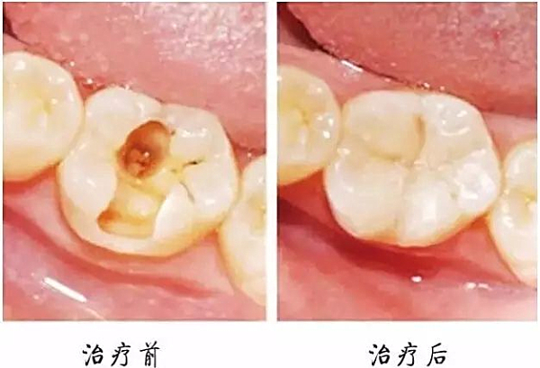 儿童有没有必要补牙？家长要知道