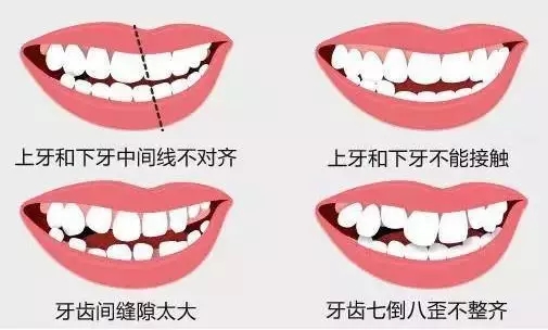 牙齿错位不简单，影响生活早治疗