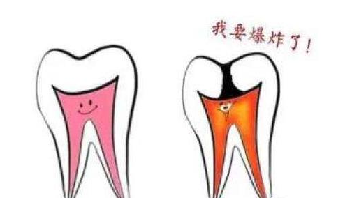 牙髓炎不只是痛，它的隐患更可怕