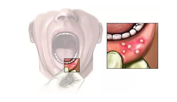 口腔溃疡不仅是因为上火