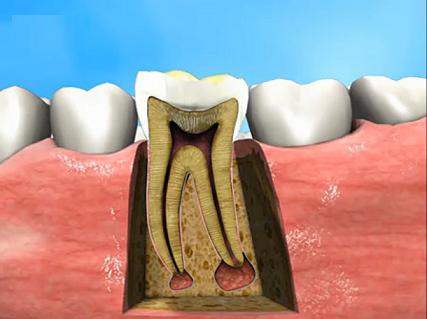 根尖周炎的治疗和预防