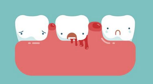 牙龈出血很常见，但也可能不简单