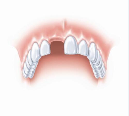 单颗牙缺失，做种植牙好还是烤瓷牙好？