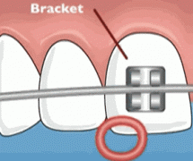 牙齿矫正，使用自锁托槽的好处在哪？
