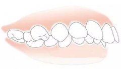 成人常见龅牙矫正方式