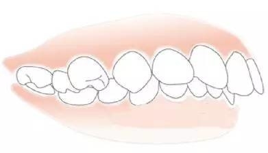 龅牙严重影响着面部美观,对于儿童时期龅牙