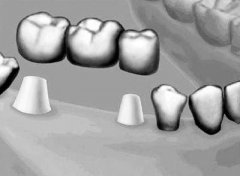 牙齿缺失修复方法之固定义齿修复