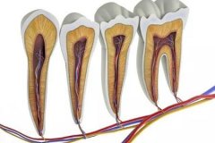 牙髓炎急性处理之牙髓摘除术