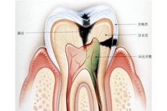 慢性牙髓炎如何预防？