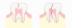 注意，没蛀牙却牙痛可能是牙隐裂