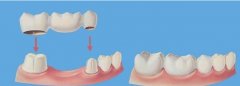固定假牙，您要知道这些