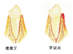 预防牙龈炎，让牙齿更健康