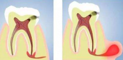 根尖周炎小知识