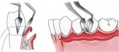 龈下刮治小知识