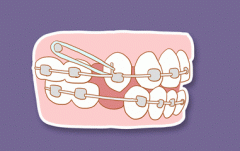 牙齿矫正适应症
