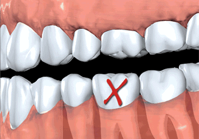 遇见先天性缺牙怎么办？