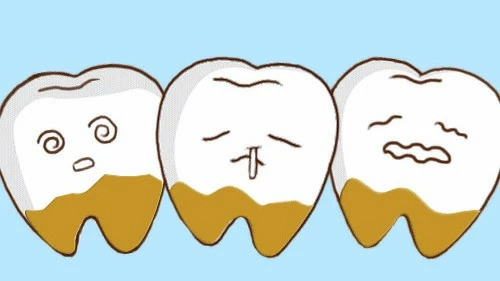 牙结石日常预防