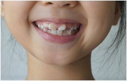 你家孩子的牙齿可能正被这些习惯毁掉