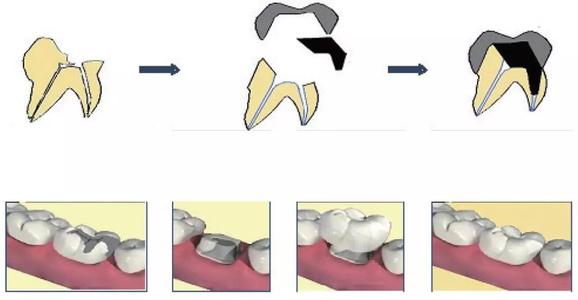 牙体缺损修复，断牙重生