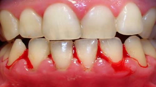 牙龈炎的护理原则