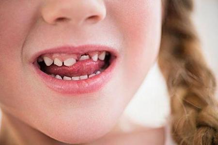 5招预防儿童牙齿畸形