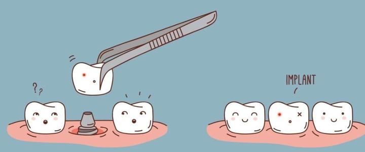 种植牙术前检查很重要