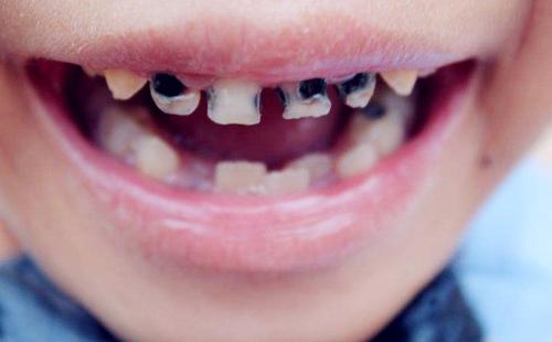 孩子牙齿又黑又黄怎么办？
