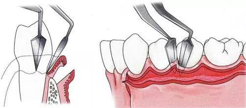 牙周刮治3大问
