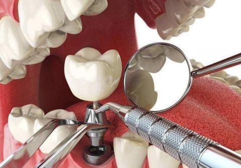 种植牙术后疼痛怎么办？