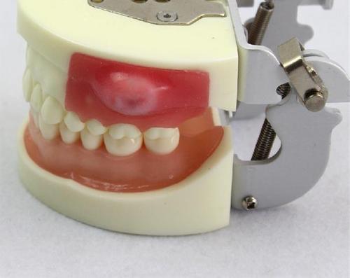 牙槽脓肿怎么治？