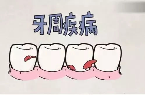 牙周病自检