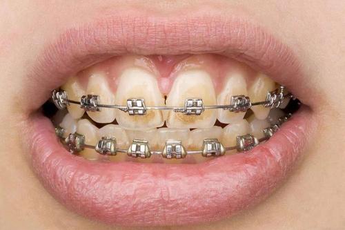 牙齿矫正后牙齿脱矿怎么预防？