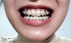 专家提示：什么样的牙齿矫正技术好呢