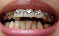 重庆牙齿矫正效果的好坏与什么有关