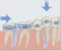 成人牙齿矫正需根据牙齿状况确定价格
