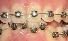重庆牙科医院提示牙齿矫正的三个黄金时间